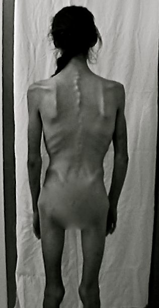 2004/2005 - 58 pounds - state of emaciation after being refused medical help in Ontario. 